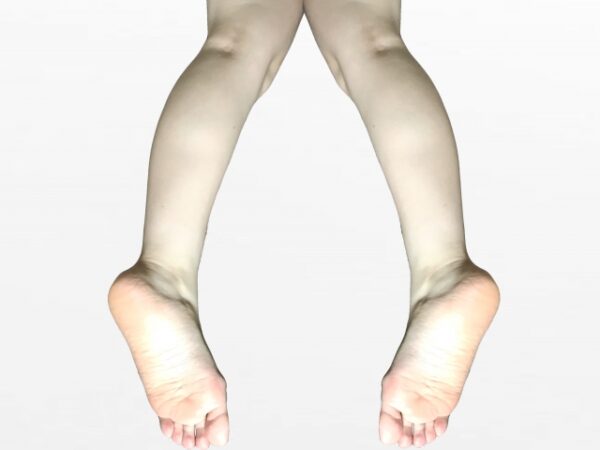 変形性膝関節症などの疾患につながるX脚を早めに改善しましょう