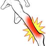 踵が痛む…アキレス腱が痛む…もしかしたらアキレス腱付着部症かも！？