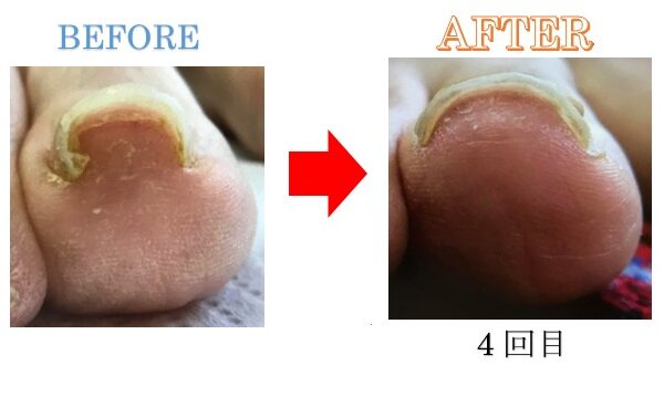 しっかり親指を使って歩けるようになり、膝や股関節痛も楽になりました！