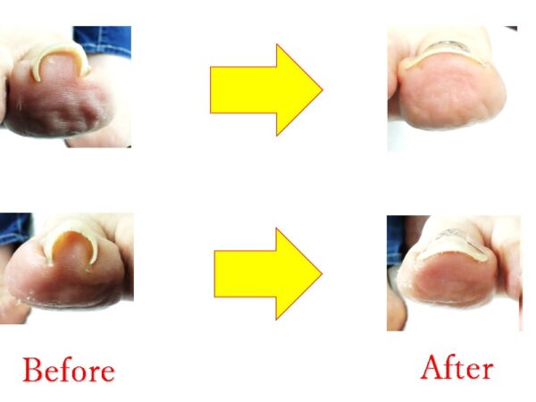 もう巻き爪再発させたくない方は、ここが一番です！