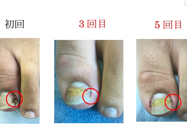 出血、痛みなど再発を繰り返していたのに、今までの苦労は何だったの